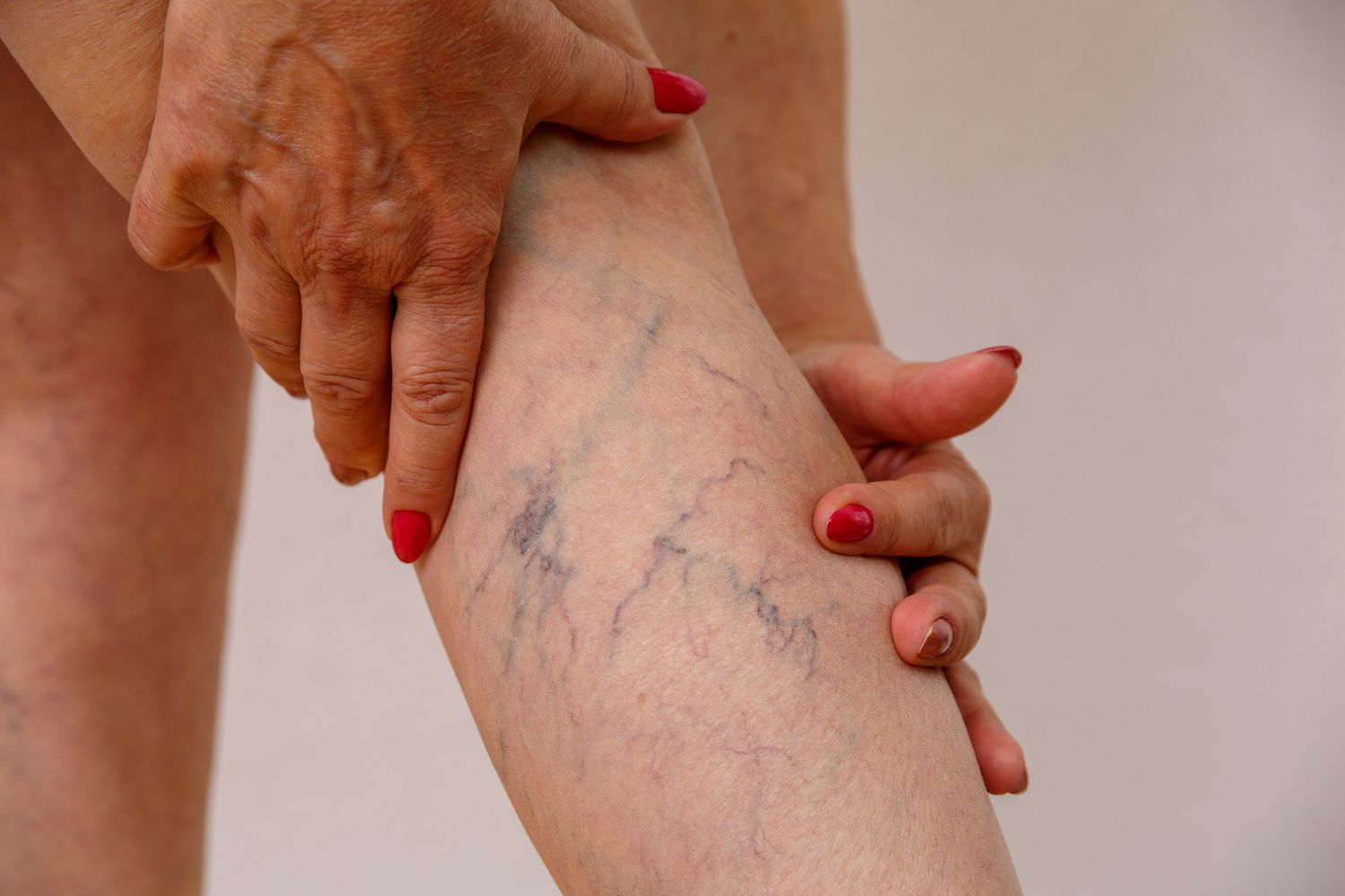 10 Cara Mencegah Varises di Kaki Sejak Dini